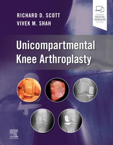 9780323790109 Unicompartmental Knee Artroplasty